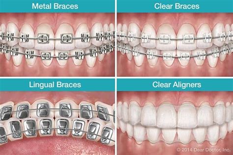 types of braces for dentists